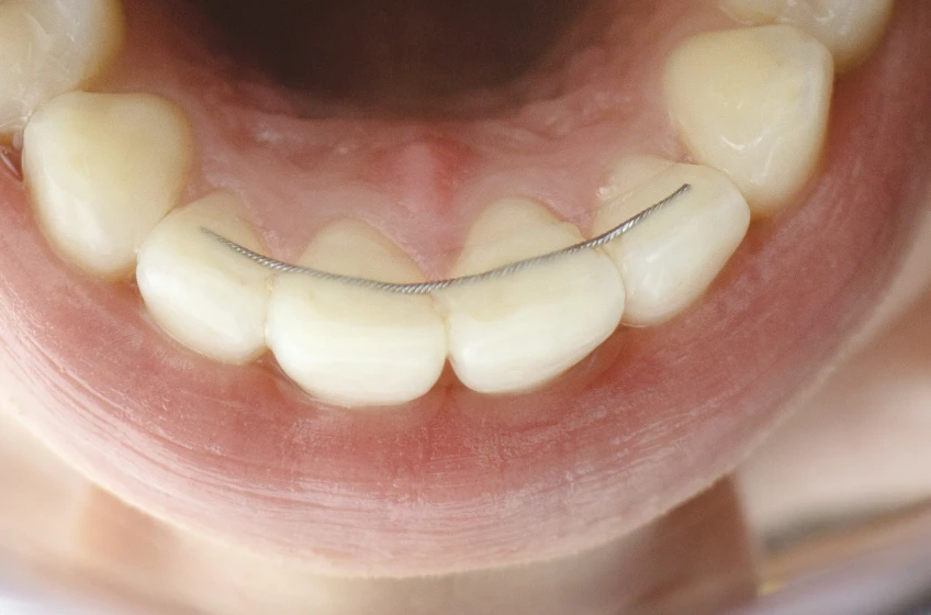 Urgences en orthodontie